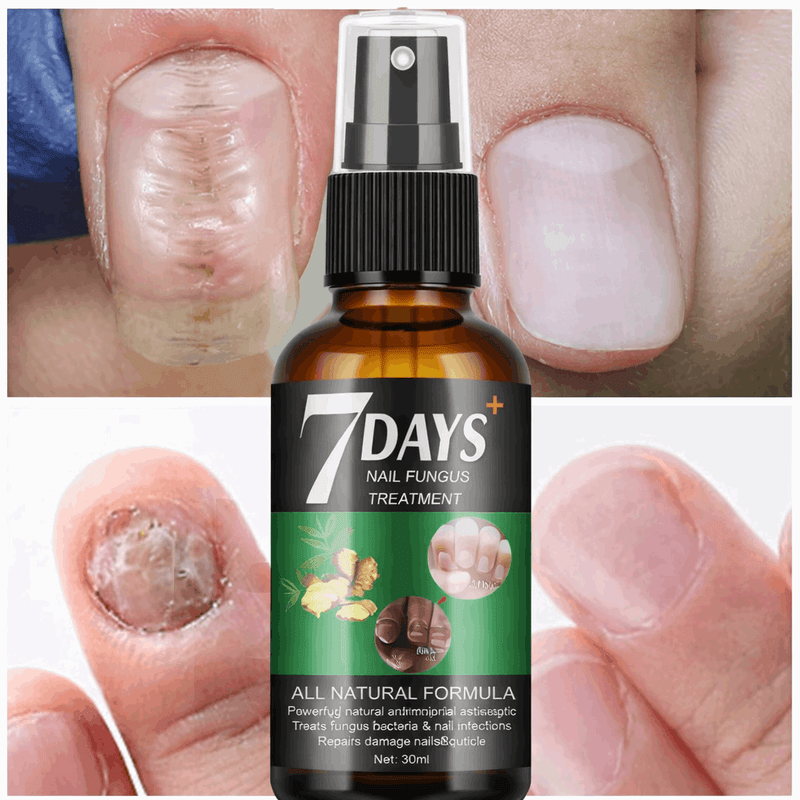 Belleza 7 Days Nails Ecuador – Trata los Hongos y Recupera tus Uñas en una Semana de Tendeli Ecuador en