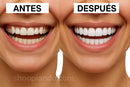 Comparativa antes y después sonrisa con blanqueamiento y alineación por carillas dentales en Ecuador Tendeli Ecuador