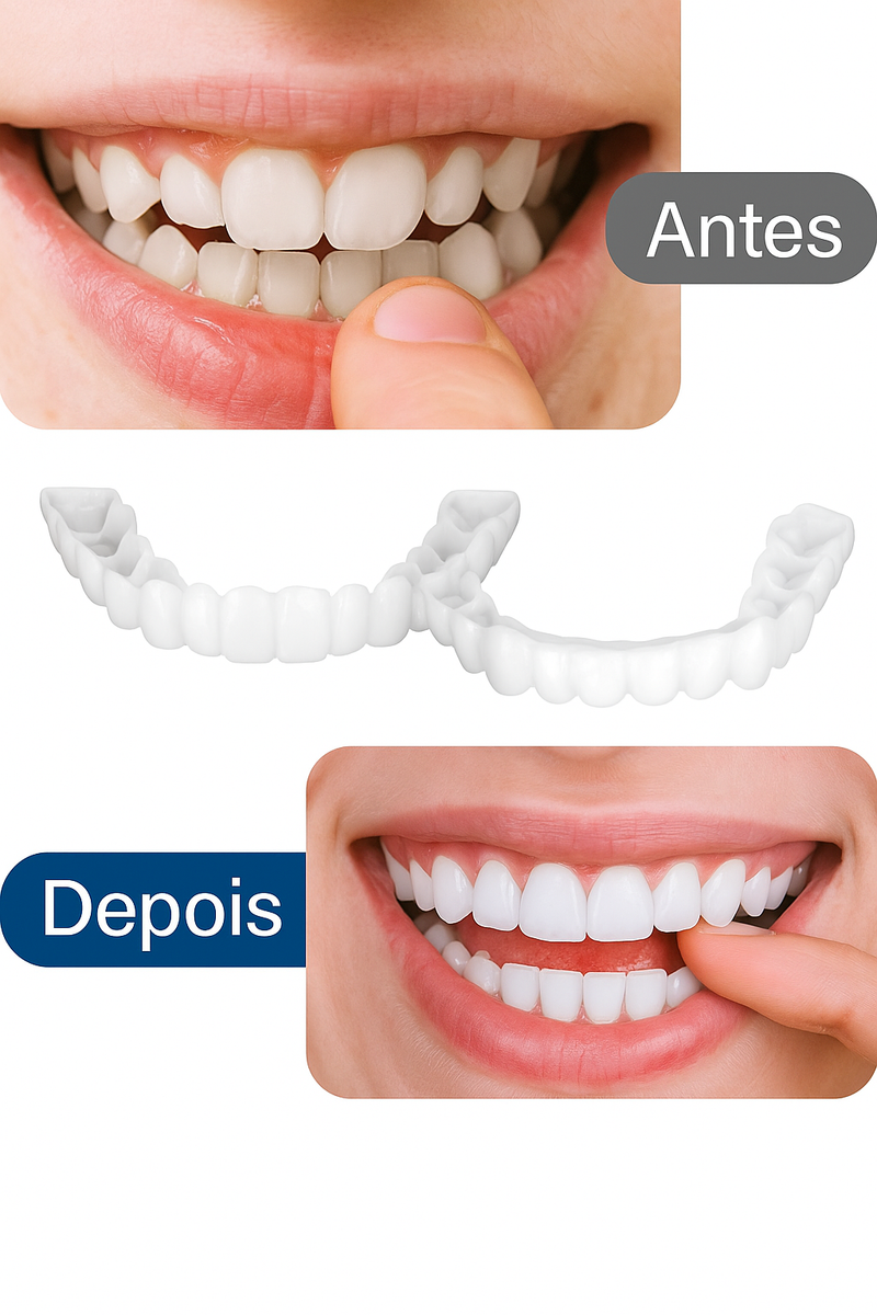 carillas para dientes temporales Ecuador imagen antes y después sonrisa con fundas dentales extraíbles de Tendeli Ecuador